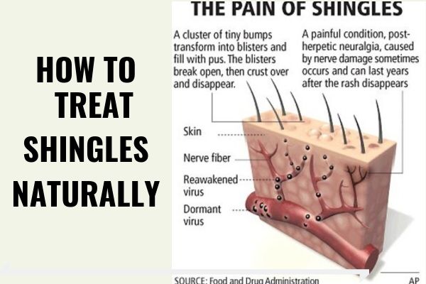 How to Treat Shingles Naturally