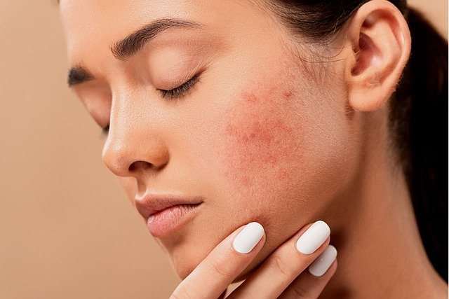 Hormonal Acne Natural Treatments