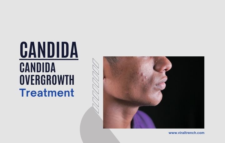 , Candida Overgrowth and Their Treatment