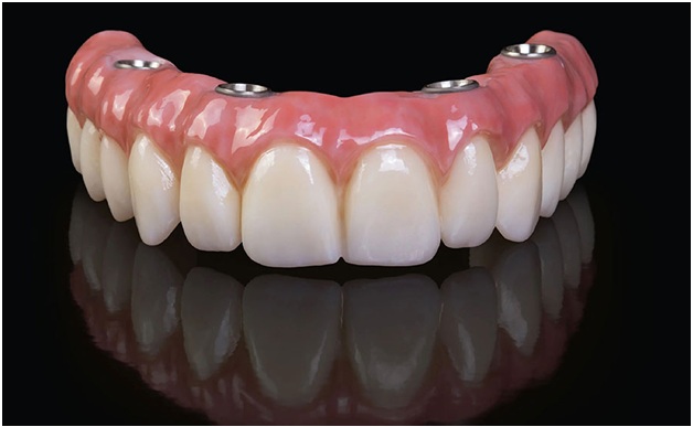 Fixed Implant Dentures