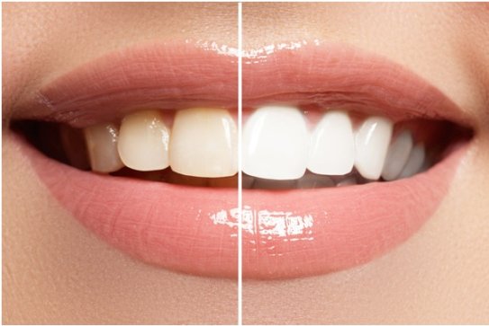 How to Get Rid of Stains Between Teeth