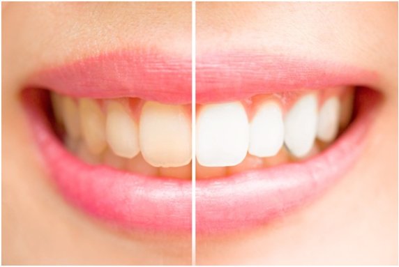 How to Fix Discolored Teeth