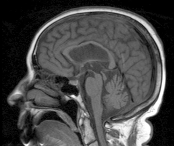 Progressive Supranuclear Palsy