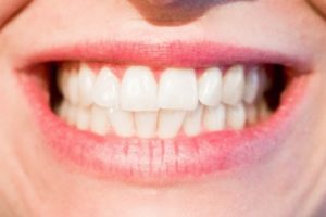 The Popularity of Veneers for the Ideal Smile