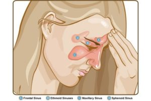 How to Get Rid of Sinus Infection