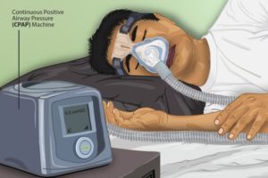 CPAP therapy