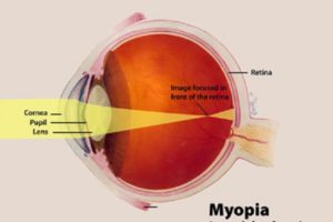 Curing Myopia