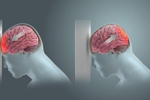 traumatic brain injury