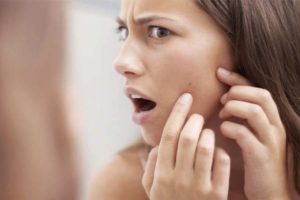 Reduce Irritation When Using Benzoyl Peroxide Wash